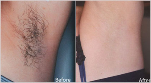 ELOS-эпиляция